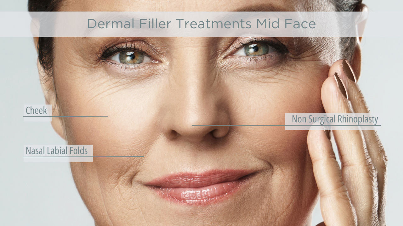 2. Dermal Fillers Mid Face