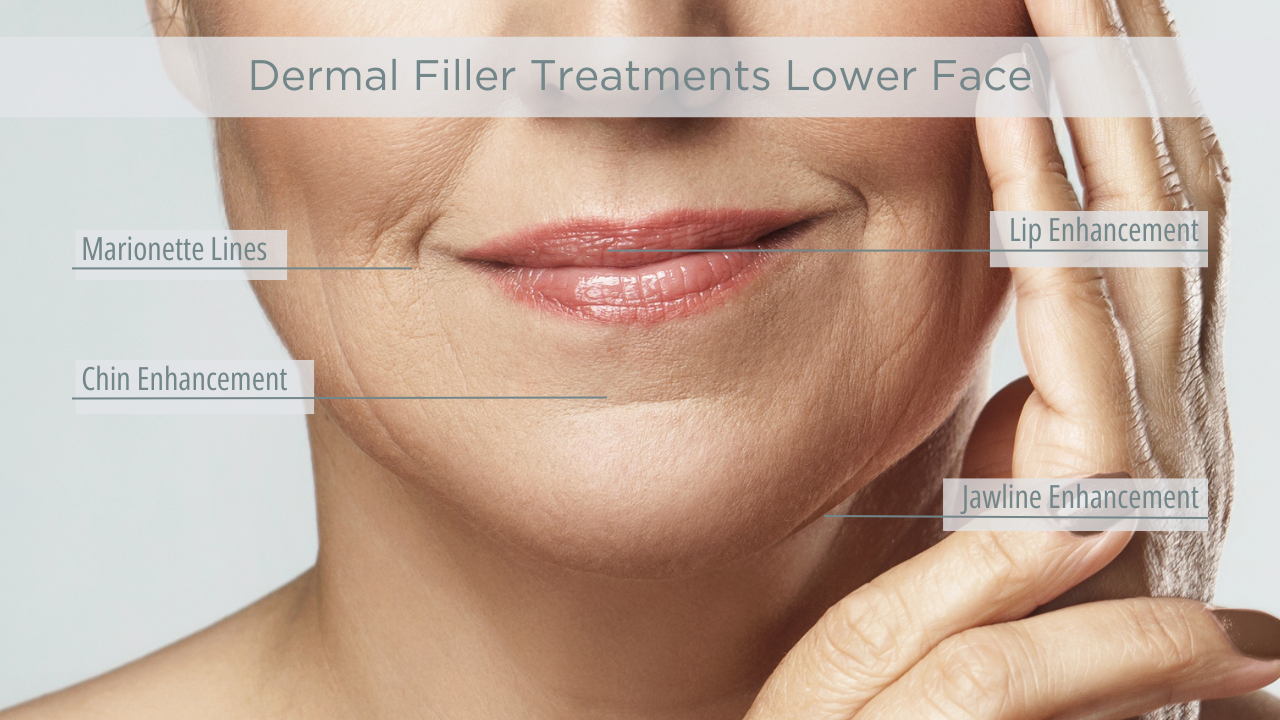 3. Dermal Fillers Lower Face